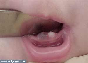 Киста прорезывания..