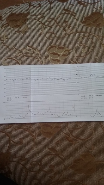 Вопрос про СХВАТКИ в КТГ!!!