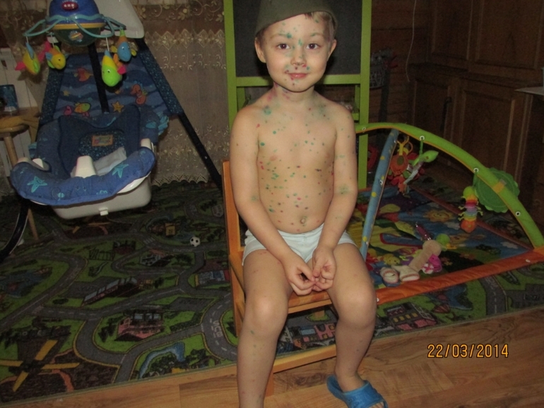 Ветрянка отступает!