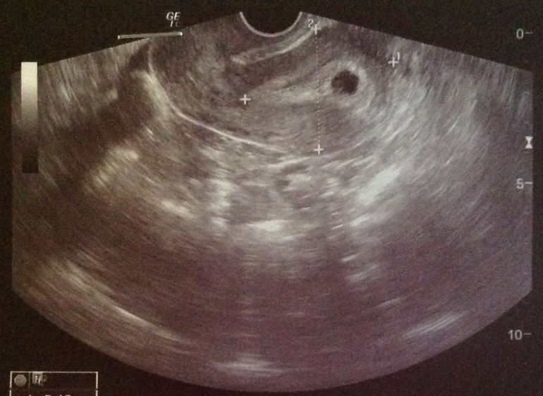 Ура!:) Беременность маточная, 3-4 недели!:)