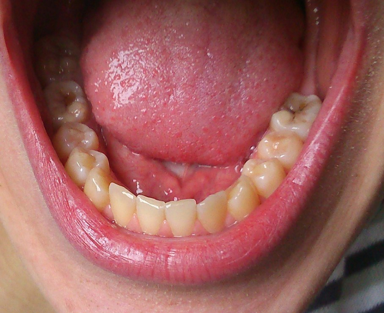 Кариес на нижних