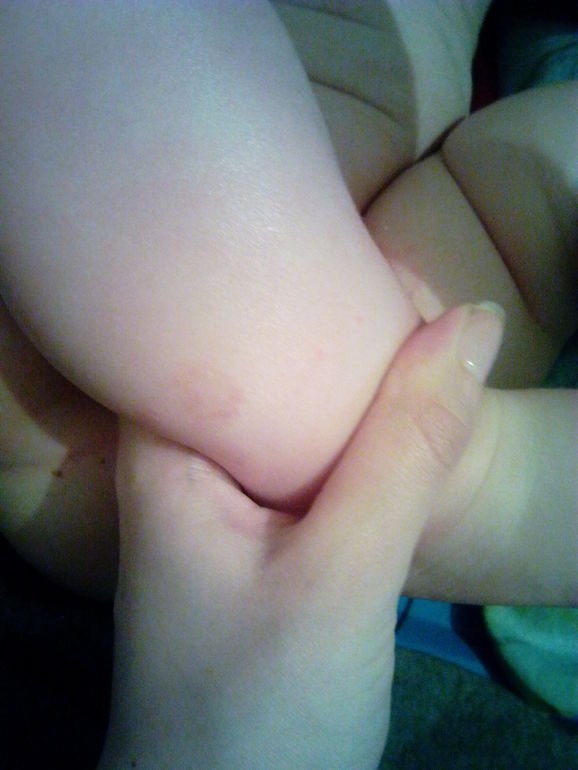 Покраснения на коже