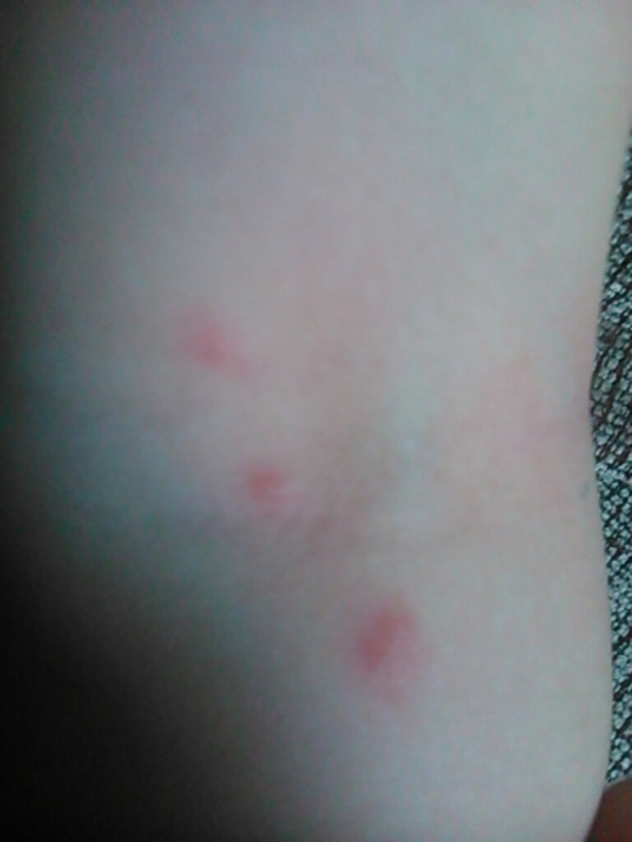 Ветрянка. Да или нет? А завтра летим отпуск....