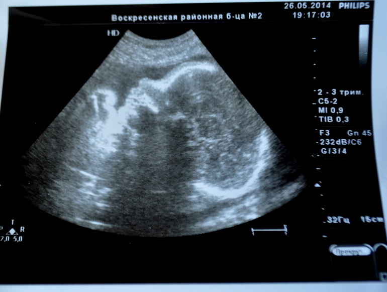 А вот и мы!))   (УЗИ+моё фото)