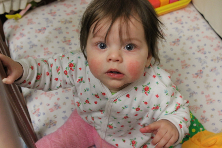 Аллерния на смесь