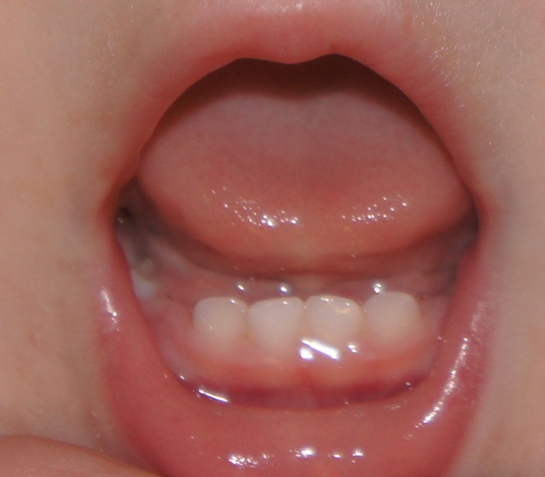 налет или кариес