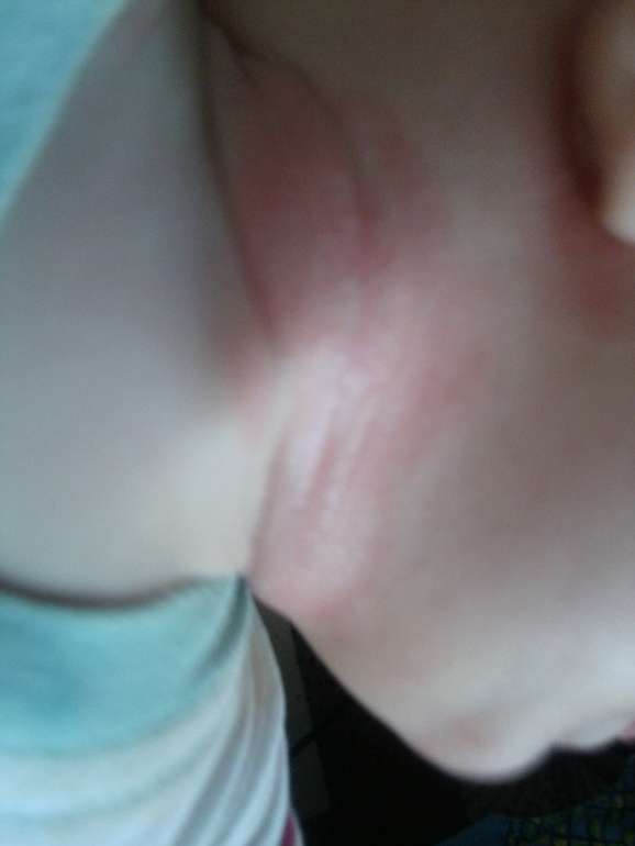 Сильное покраснение на шее