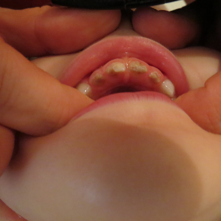 Кариес молочных зубов