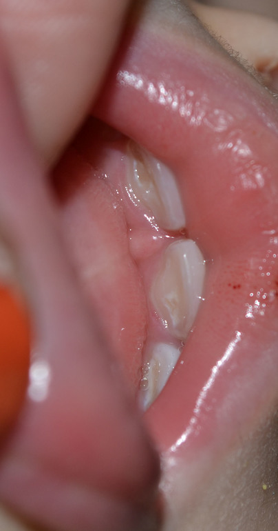 Бутылочный кариес