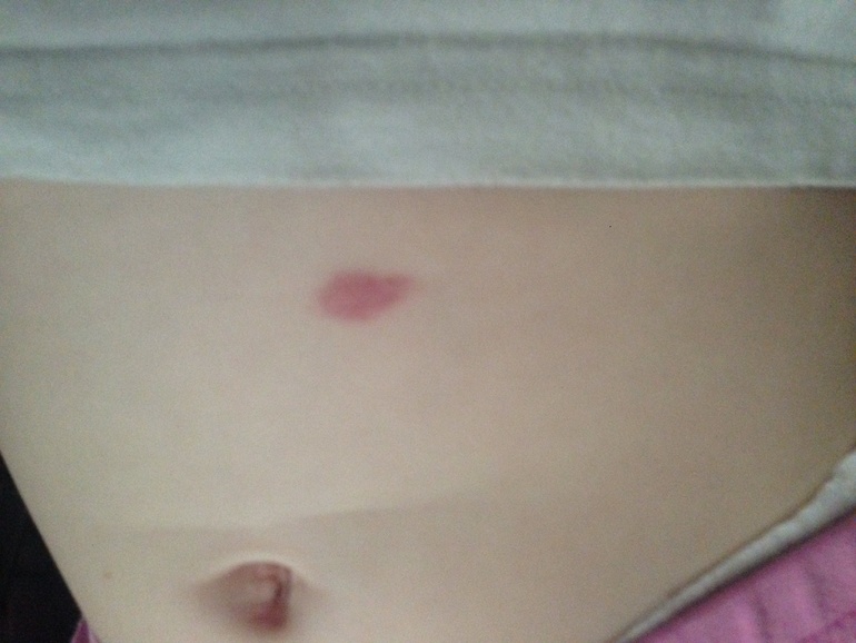 Ветрянка или нет?