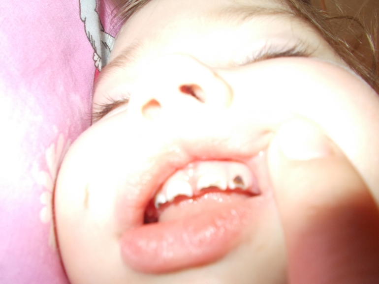 Подскажите на какой стадии разрушение??