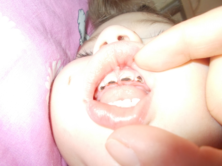 Подскажите на какой стадии разрушение??