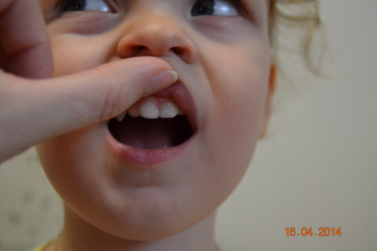 Кариес! как лучше нам его вылечить?