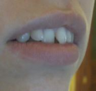 Что можно сделать ?Один зуб ниже других