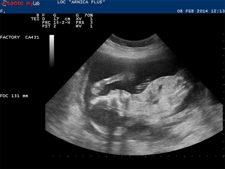 Второе УЗИ )))