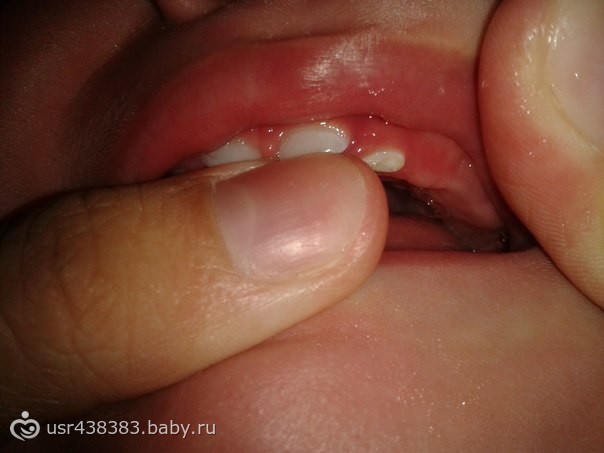 что с зубками?