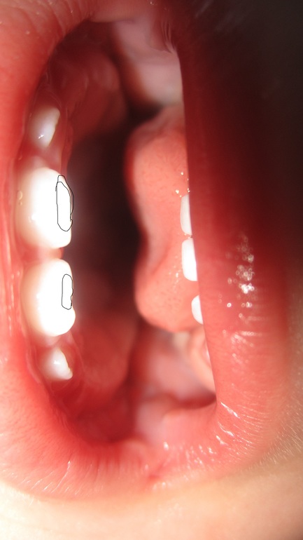 Что с зубками?