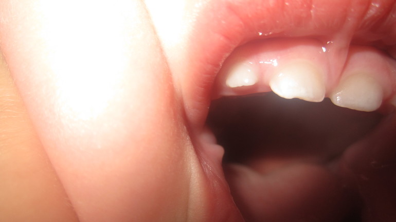 Что с зубками?