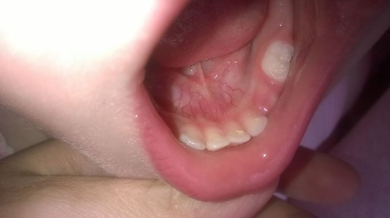 Это кариес?