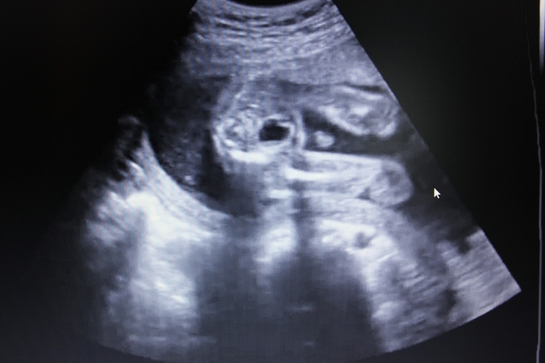 УРРРРАААААААААА!!!!!!!!!!! УЗИ в 21 неделю)))))))