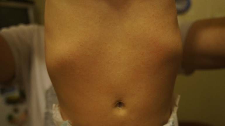 Что за сыпь на животе (5.5мес)?