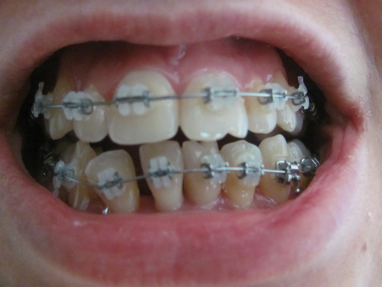 Брекета - продолжение 4