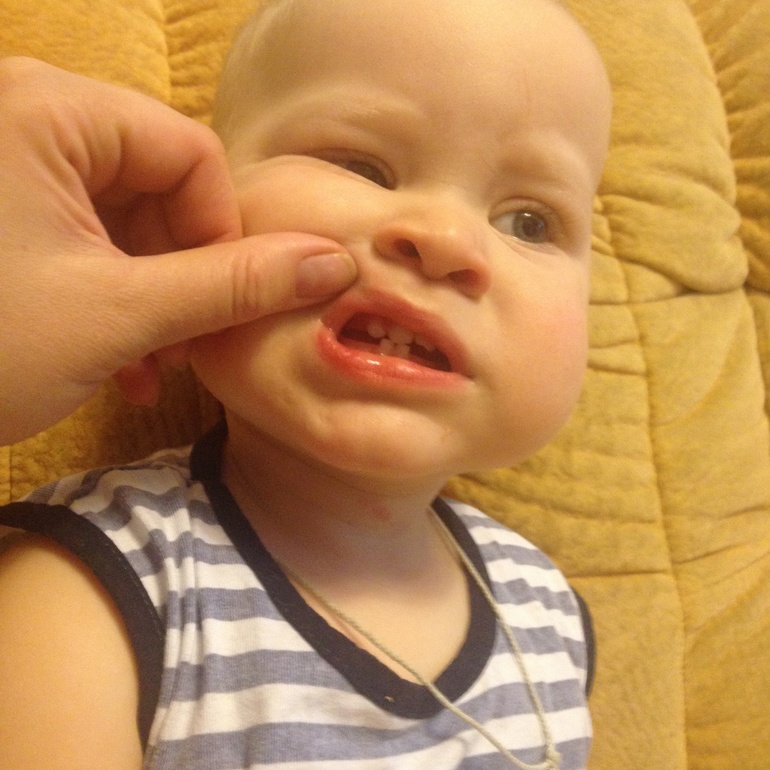 Ударились лицом в автобусе, сломали зубик:(