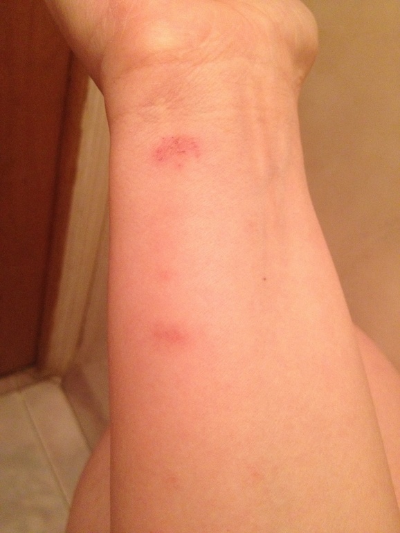 Болячка на губе !!!