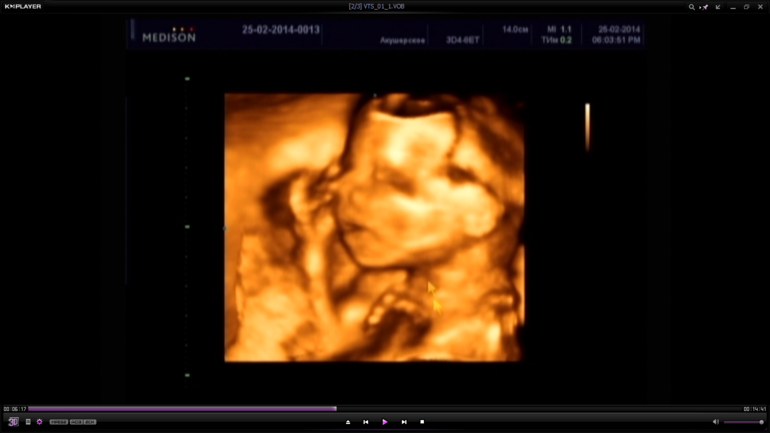 История моей Б, пишу на память для себя)))