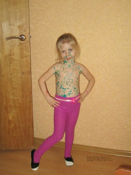 Ветрянка у Ники...