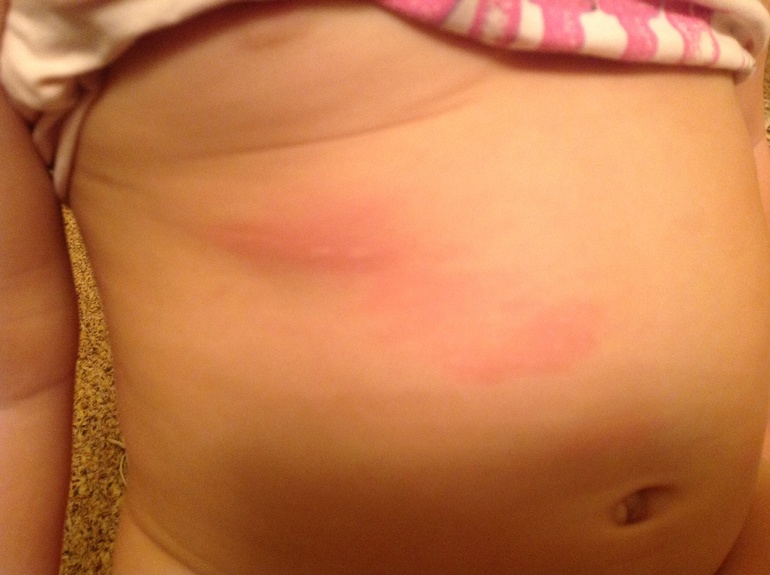 Сыпь! Краснуха? Ветрянка? Или что то еще?