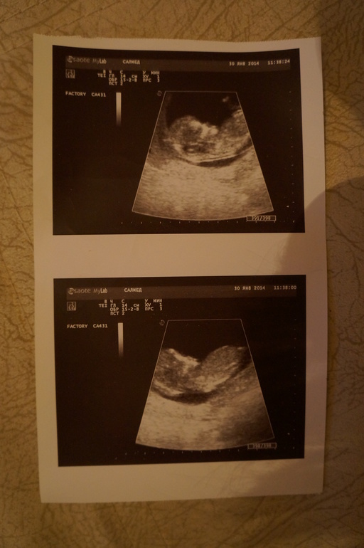 УЗИ, пузик и пол!