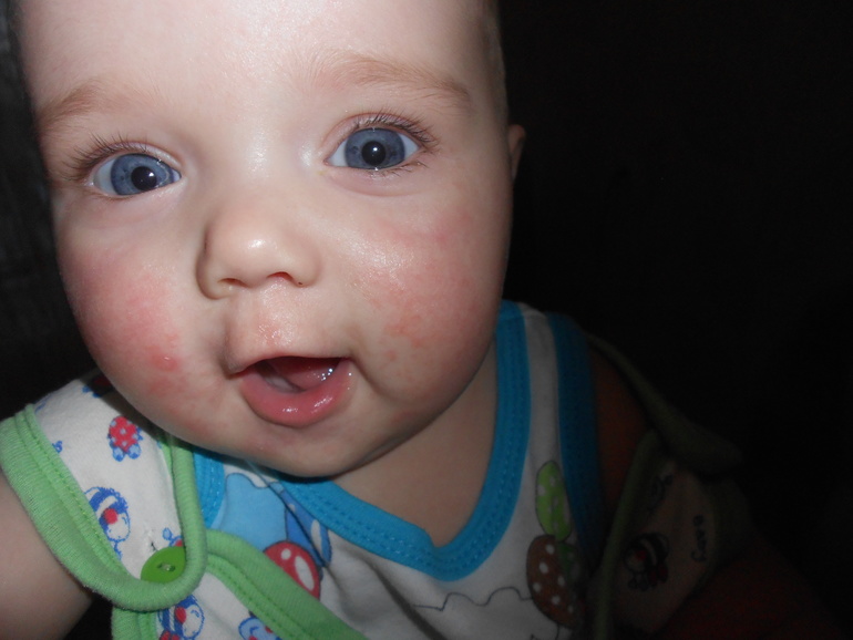 Скажите пожалуйста!!!!Что за сыпь?