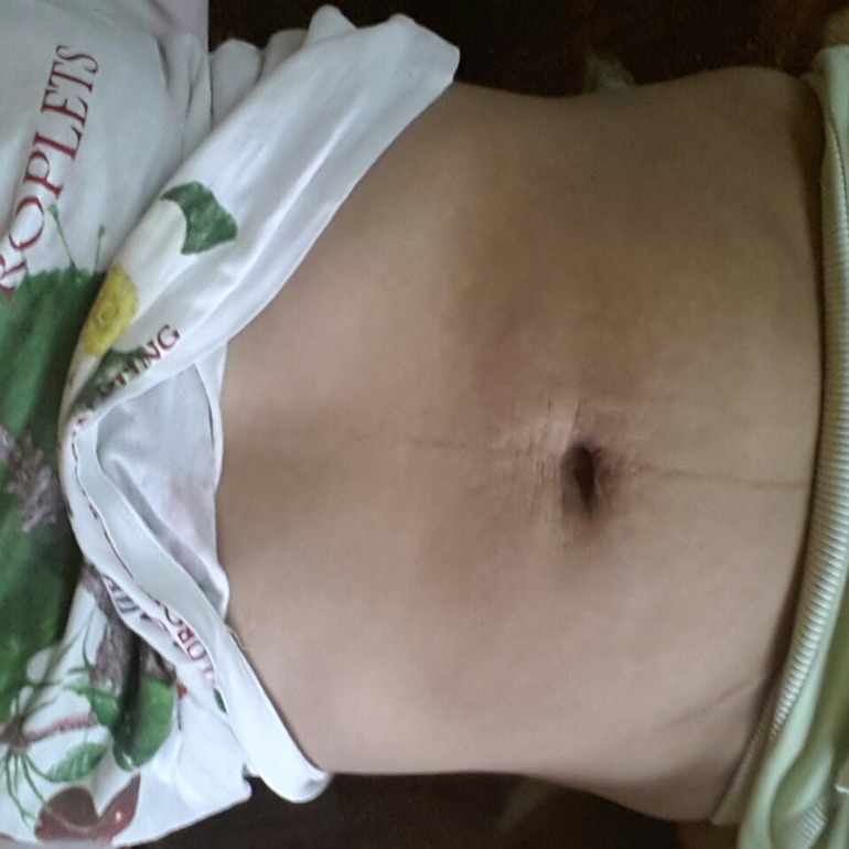 Что делать с растяжками?