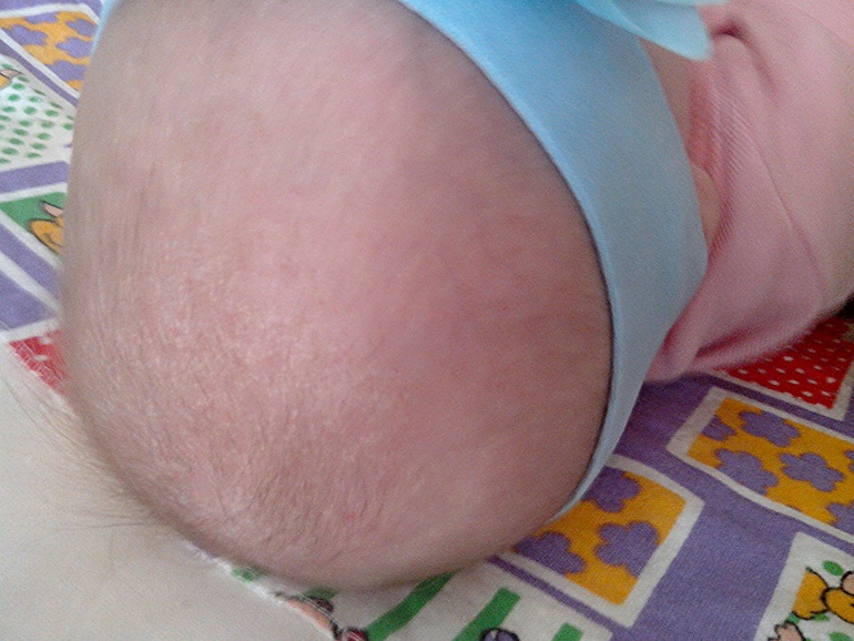 Шелушится кожа головы у малышки...