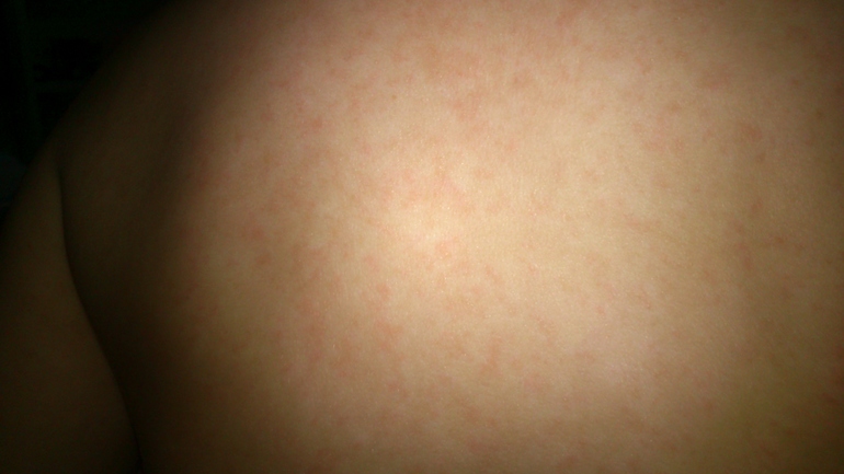 Аллергия или краснуха?