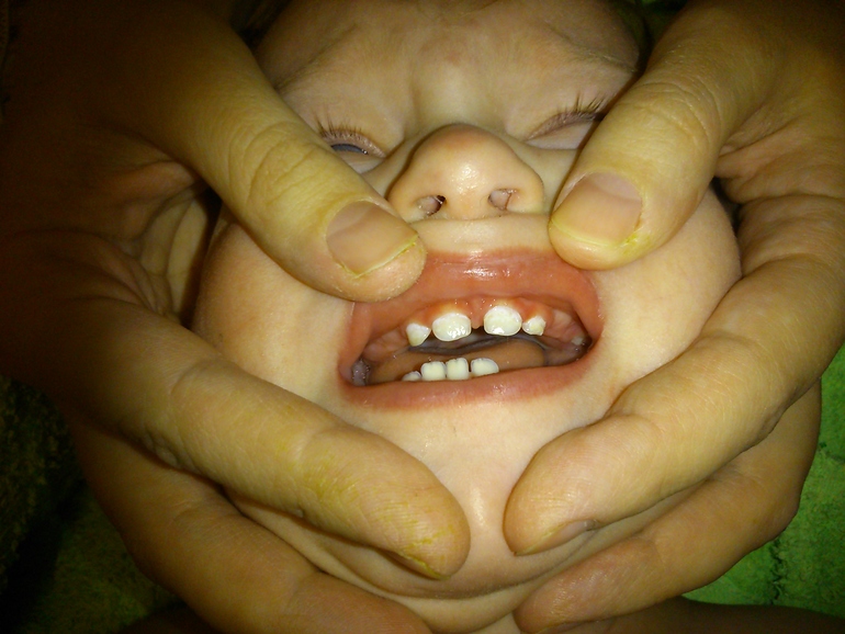 Налет и скол резца