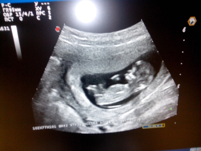 Наш 1-ый скриниг! Моя любимая детка, моя радость, моя жизнь!!!!!