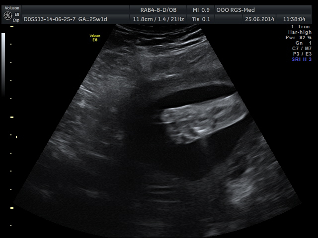 3D УЗИ на сроке 25 недель и 1 день)))))Фоточки))))