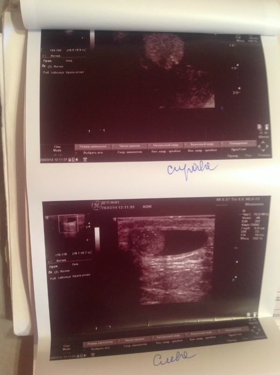 Водянка+гипоэхогенная струтура и включения в яичке!