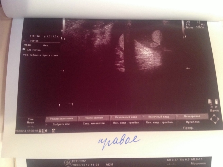 Водянка+гипоэхогенная струтура и включения в яичке!