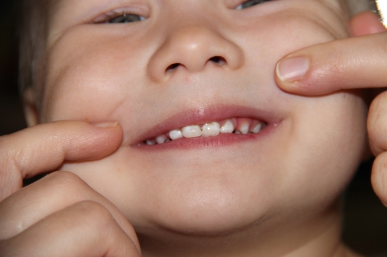 Какая стадия кариеса у ребенка 2,4 лет