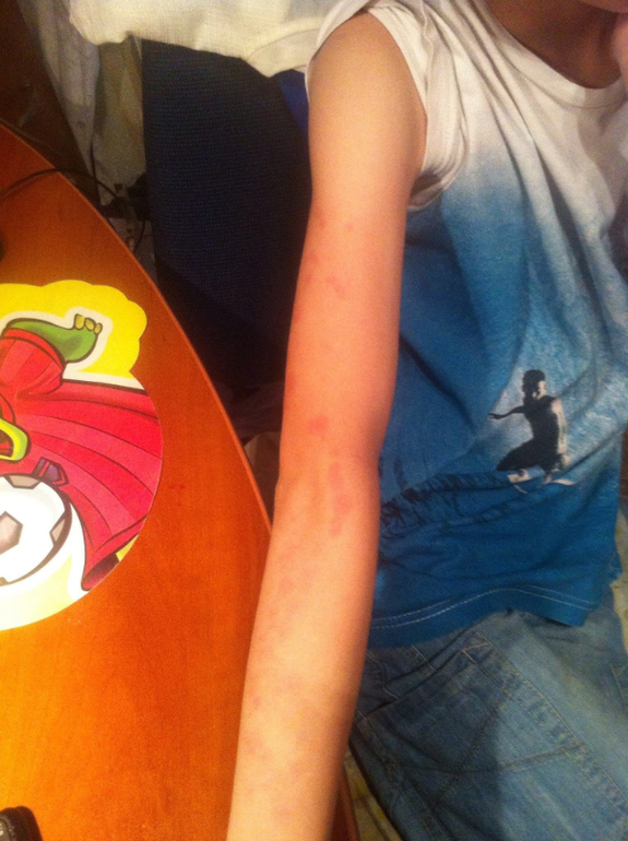 Острая крапивница посетила нас(