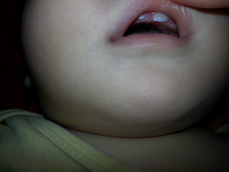 Гипоплазия Эмали?