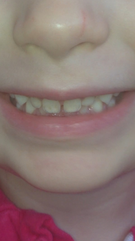 Пятнышки на зубе