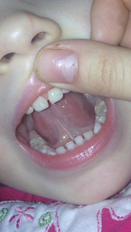 Пятнышки на зубе