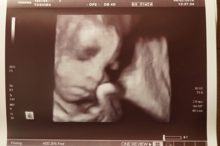 Сон мужа и результат узи.... )))))