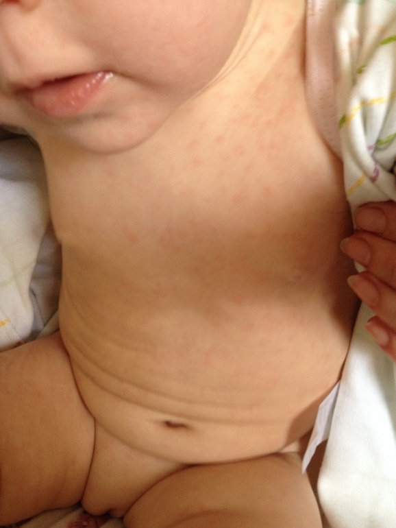 SOS помогите разобраться с генезисом сыпи