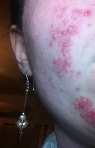 Время идет а лучше не становиться....акне