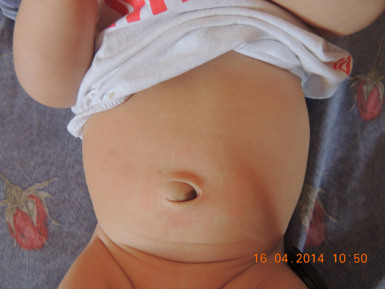 Опять про грыжу